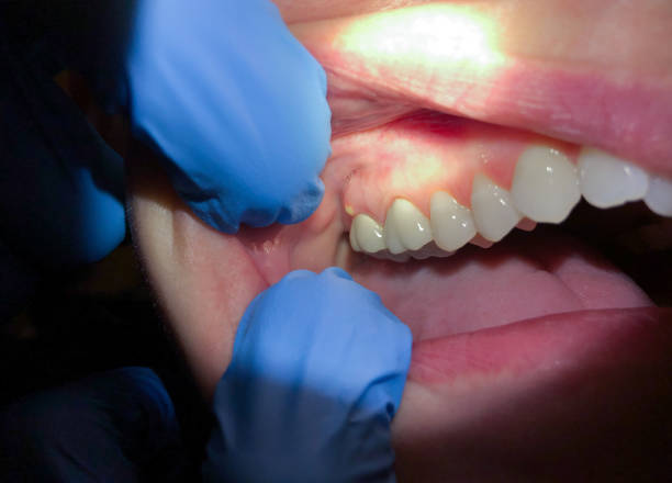 Best Lost Filling or Crown Replacement in Woodbury Center, CT